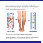 Varicose Veins 30ml Treatment Spray! - Image 6