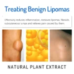 Lipoma Removal Cream (2pcs) - Image 7